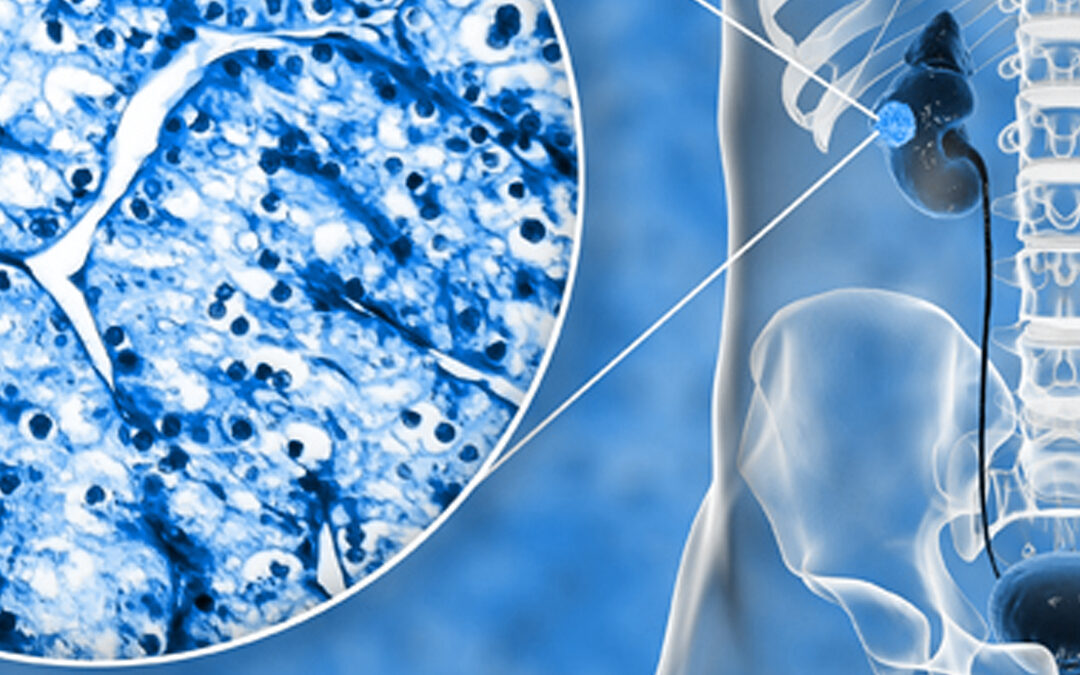 Pequeñas masas renales